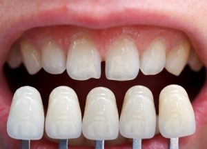 Porcelain Veneers