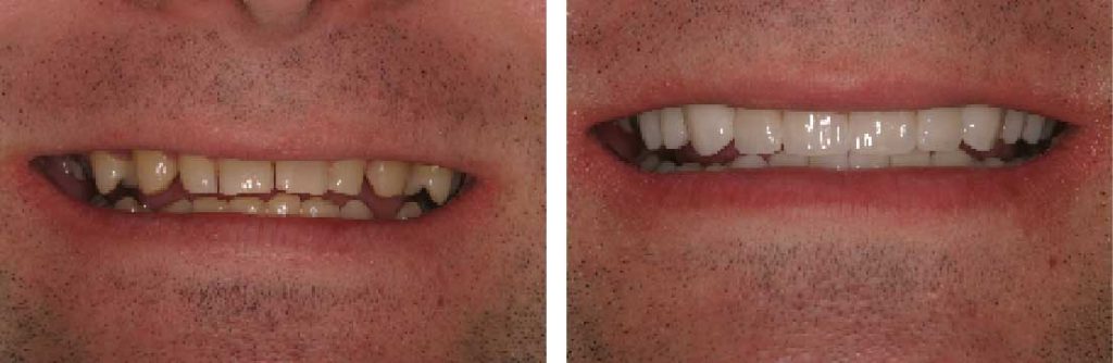 Dental before and after whitening images