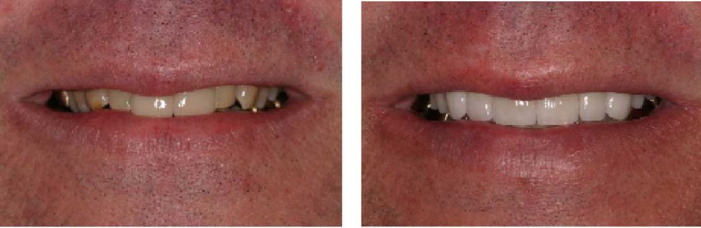 Dental before and after whitening images