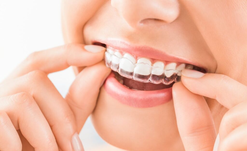 Invisalign dentist near me – Columbia Missouri patients enjoy relief from jaw pain