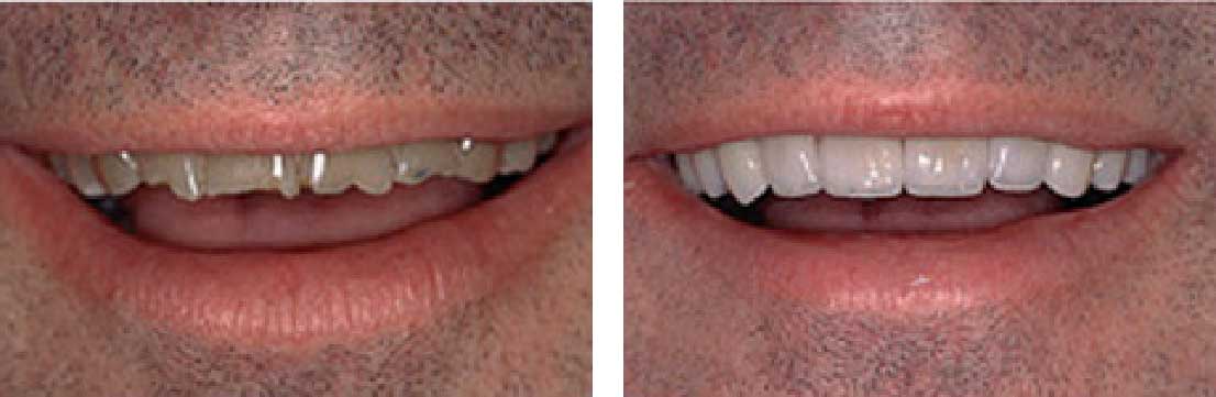 Before and After: Porcelain Crowns