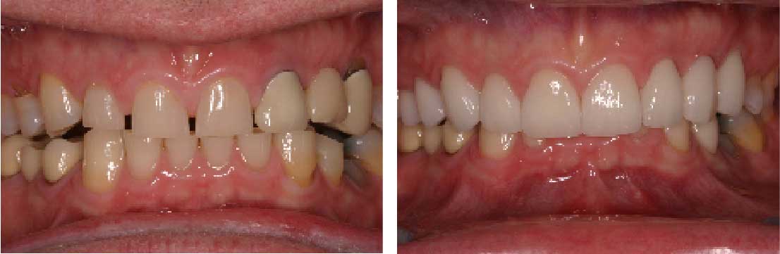 Before and After: Porcelain Crowns
