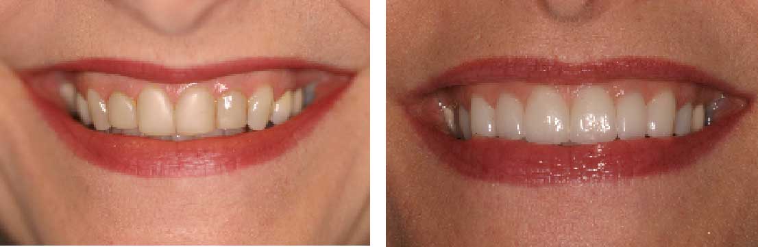 Before and After: Porcelain Veneers