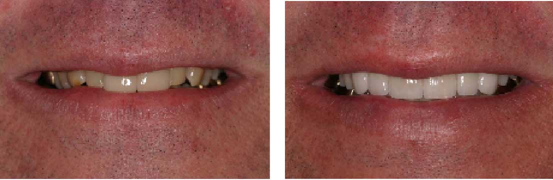 Before and After: Porcelain Veneers